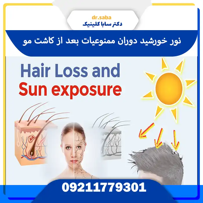 ممنوعیت بعد از کاشت مو