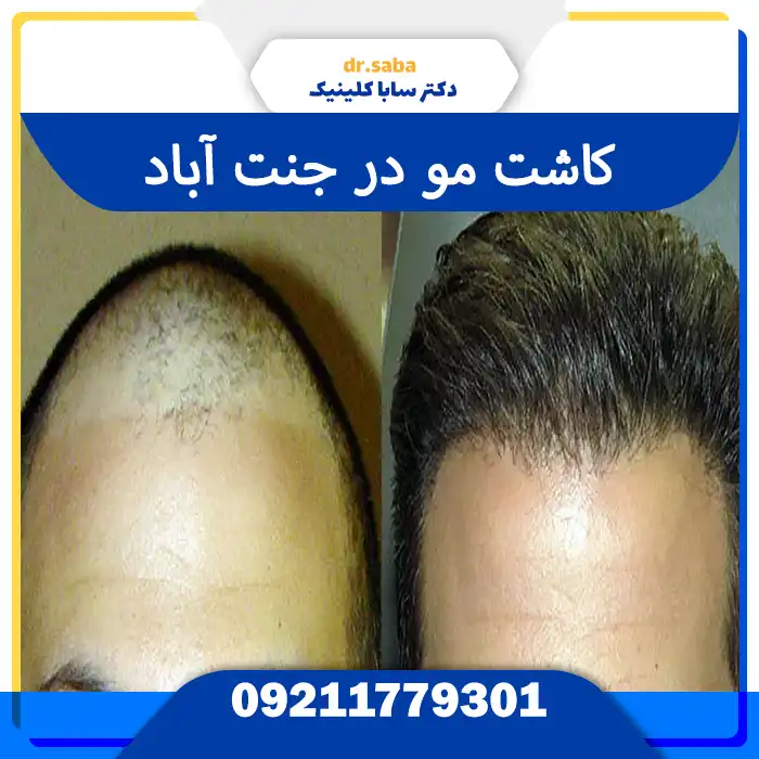 کلینیک کاشت مو در جنت آباد