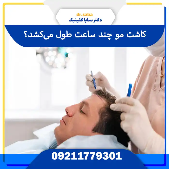 کاشت مو چند ساعت طول می‌کشد در سابا کلینیک – مراحل عمل و مدت‌زمان واقعی کاشت مو در تهران