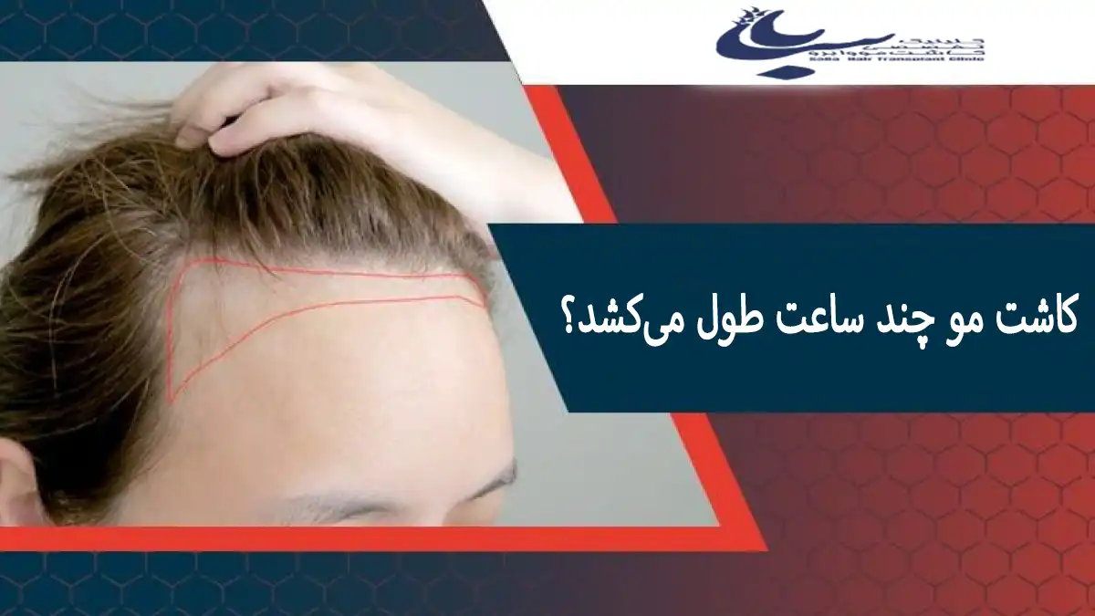 کاشت مو چند ساعت طول میکشد