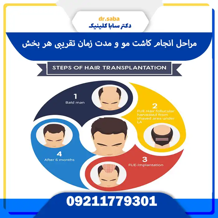 چقدر عمل کاشت مو طول میکشه