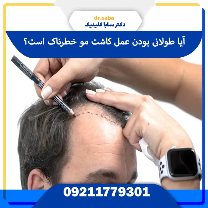 مدت زمان کاشت مو