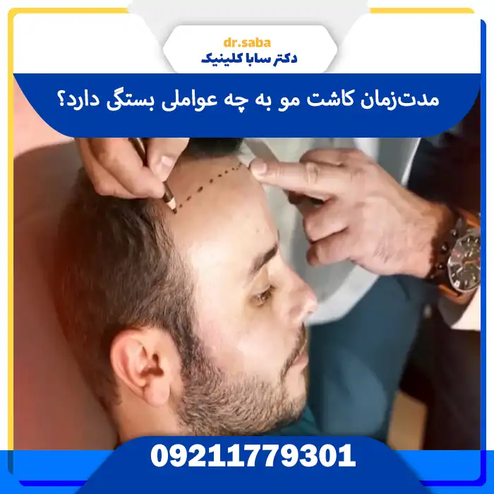 عوامل موثر بر مدت زمان عمل کاشت مو