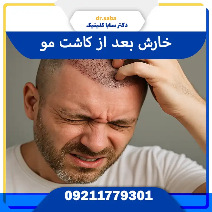 خارش بعد از کاشت مو و روش‌های کاهش آن در دوران ترمیم پوست سر