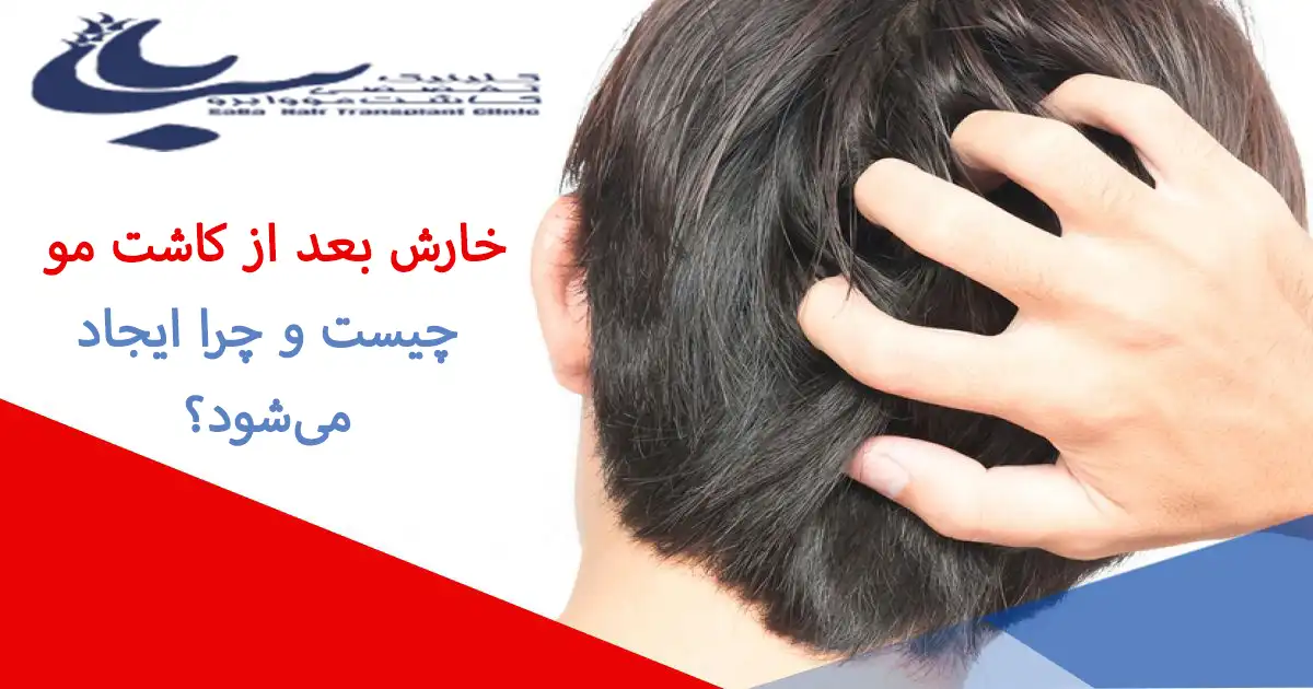 عکس خارش بعد از کاشت مو و روش‌های کاهش 
