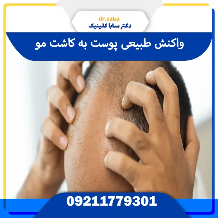 عکس خارش بعد از کاشت مو