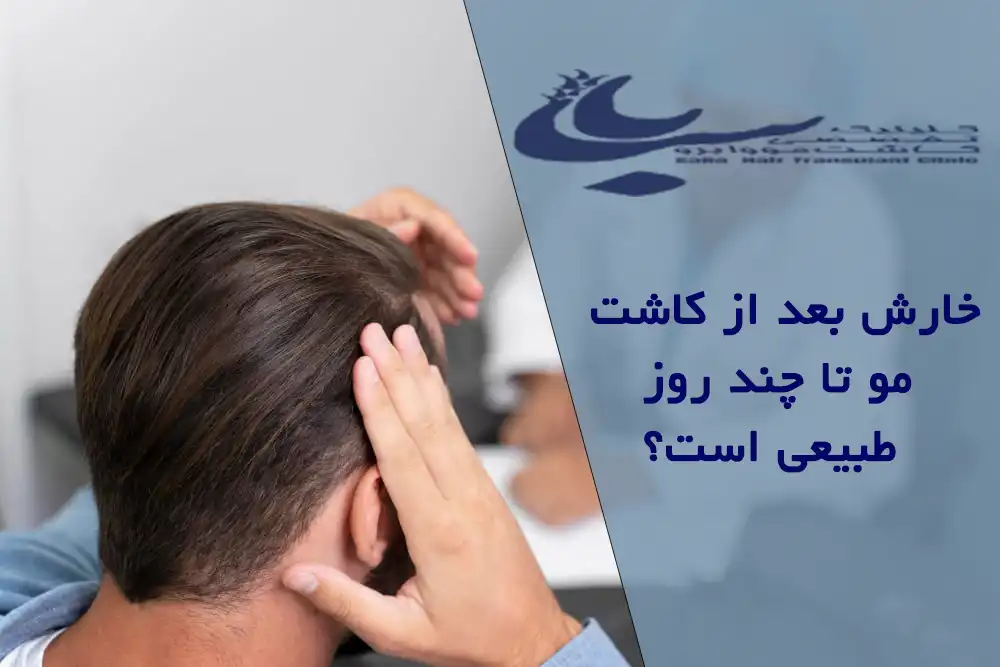 مدت خارش بعد از کاشت مو