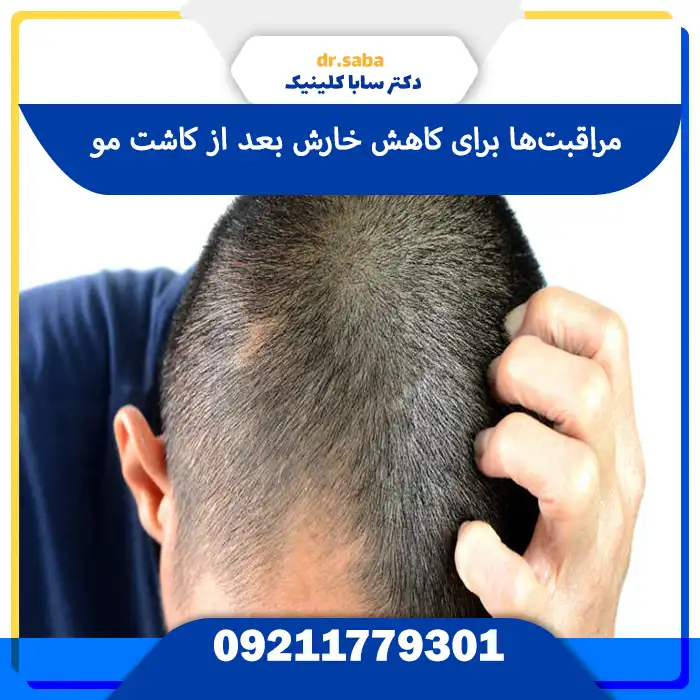  مراقبت‌های خانگی برای کاهش خارش بعد از کاشت مو