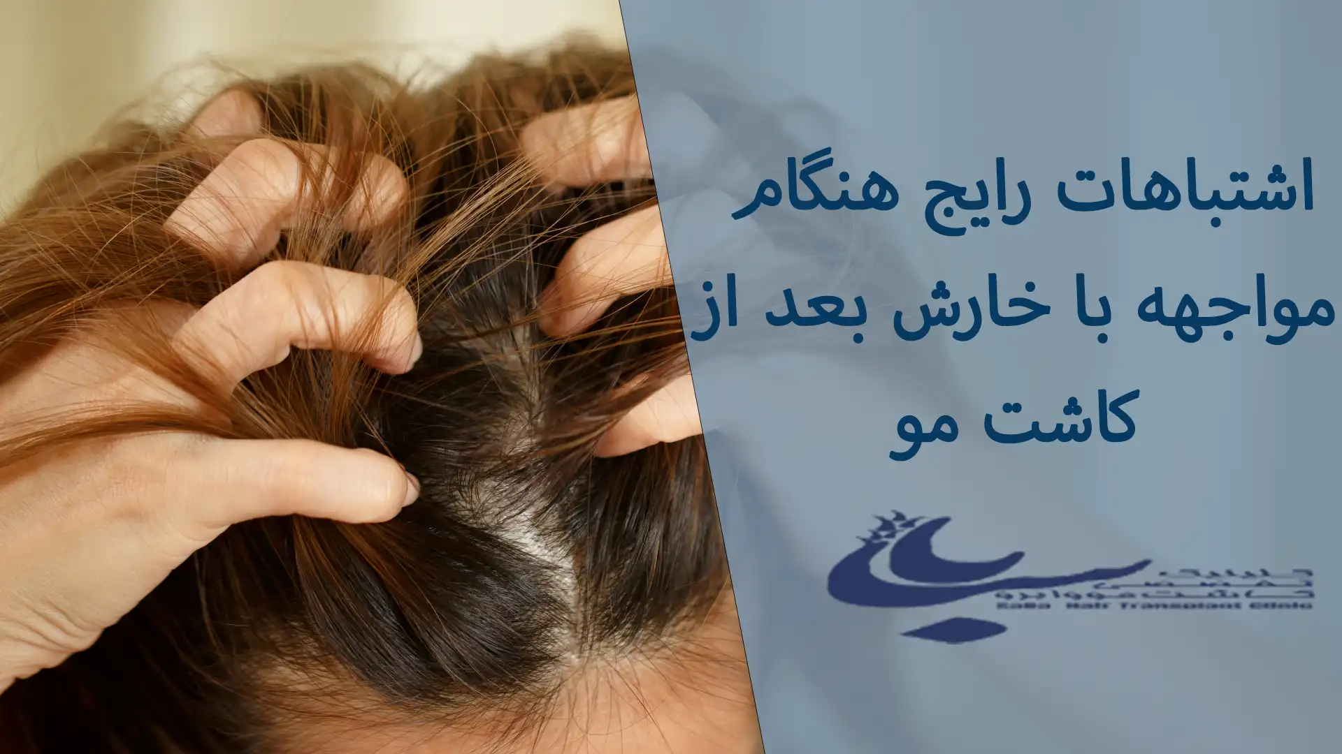 اشتباهات رایج خارش بعد از کاشت مو