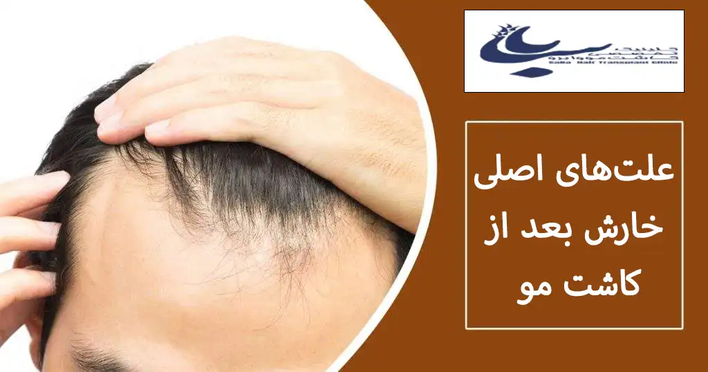 خارش بعد از کاشت مو 