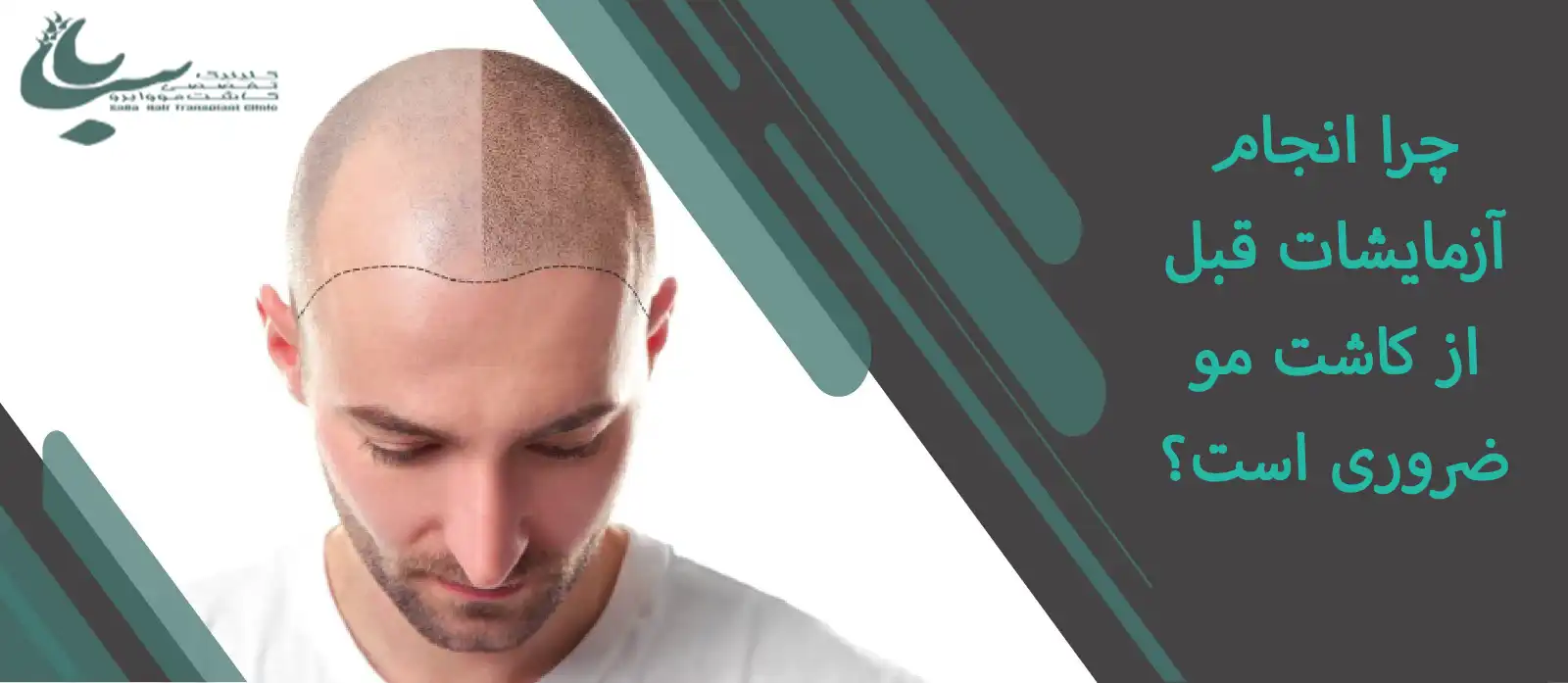 اهمیت انجام آزمایش قبل از کاشت مو