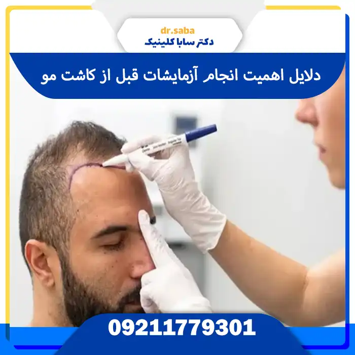 دلایل انجام آزمایشات قبل از کاشت مو