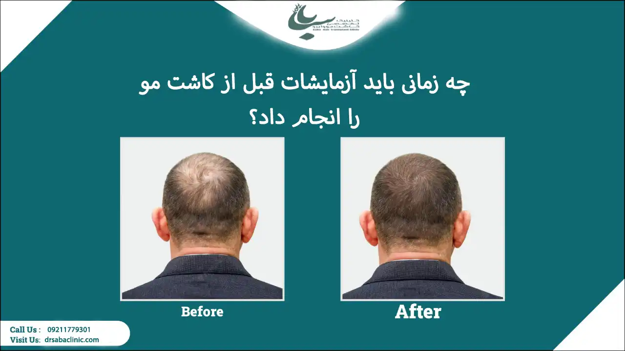 زمان انجام ازمایش های قبل از کاشت مو