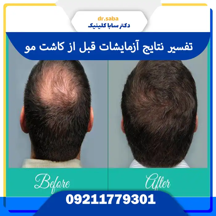 نتایج آزمایشات قبل از کاشت مو