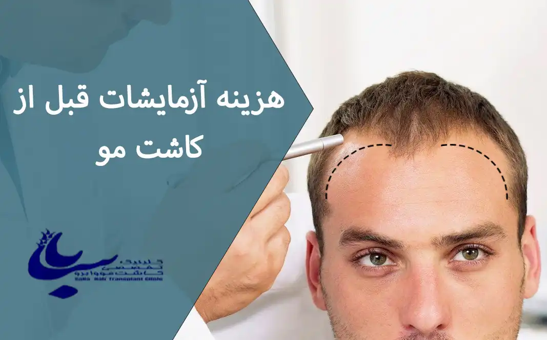 هزینه آزمایشات کاشت مو