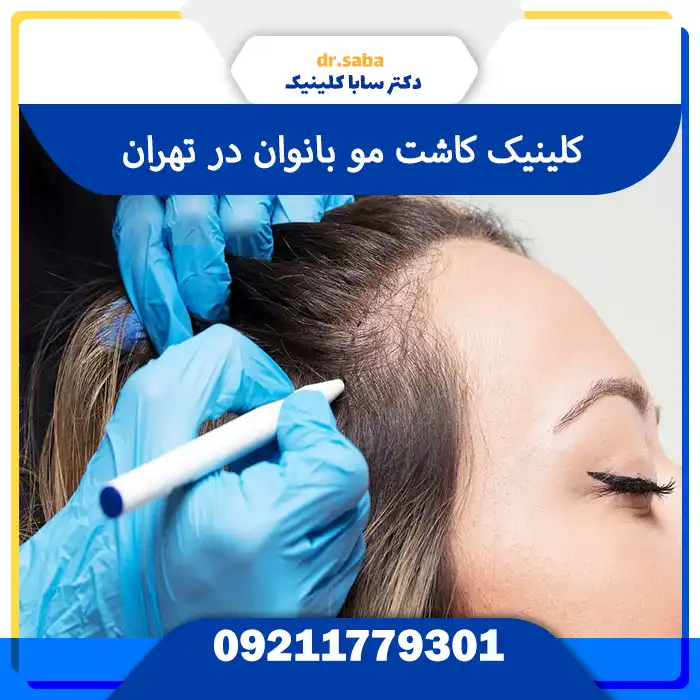 کلینیک کاشت مو زنان در تهران – کاشت موی طبیعی و بدون تراشیدن مو با ظاهری زنانه و زیبا در سابا کلینیک