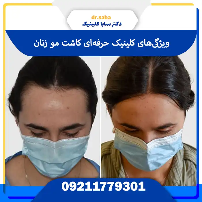 کلینیک کاشت مو بانوان