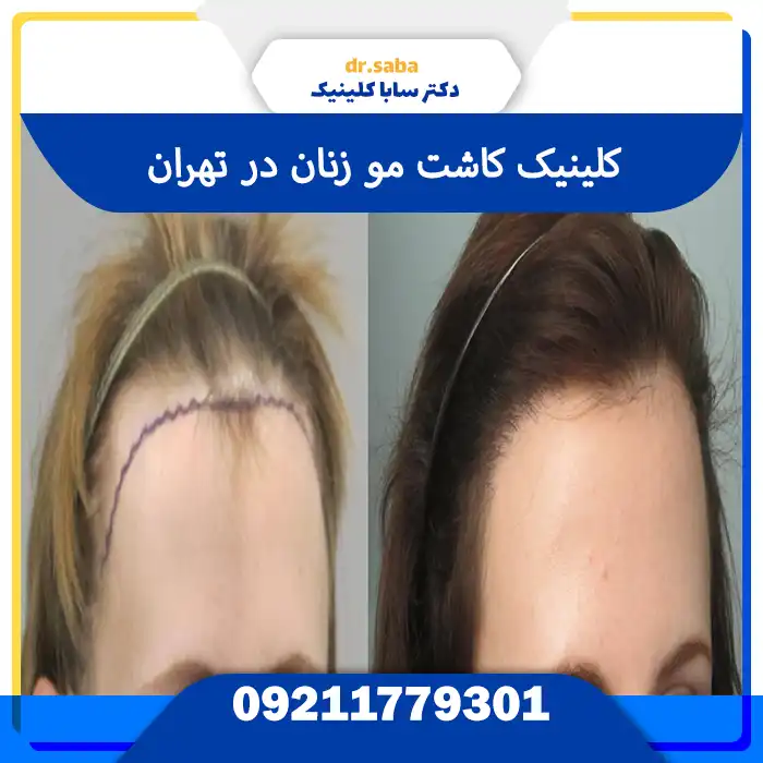 کلینیک معتبر در کاشت مو بانوان