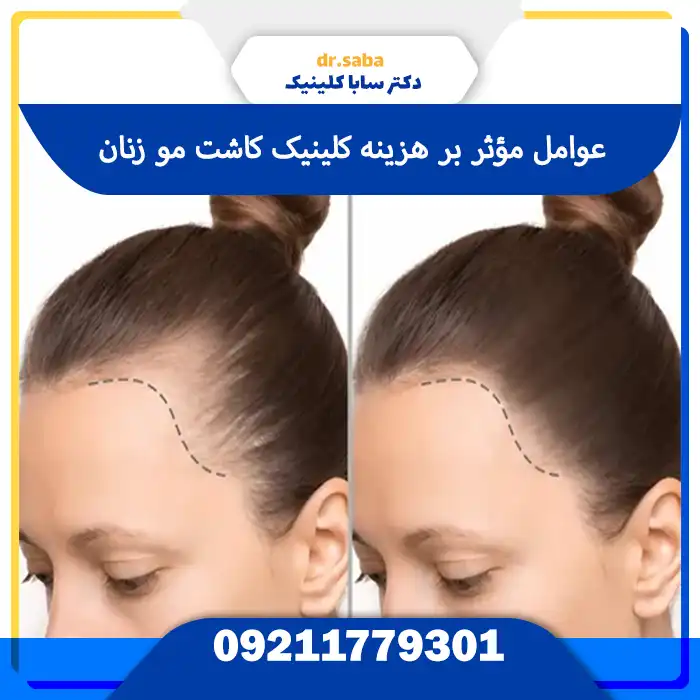 عوامل موثر بر هزینه کلینیک کاشت مو بانوان در تهران