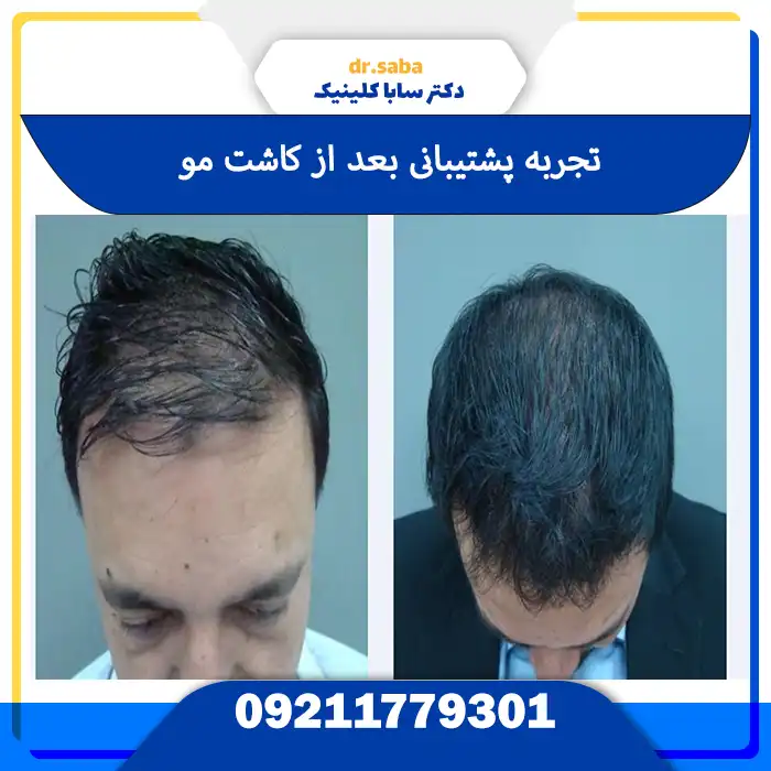 مشاوره تخصصی بیماران در بهترین کلینیک کاشت مو در تهران از نظر مردم