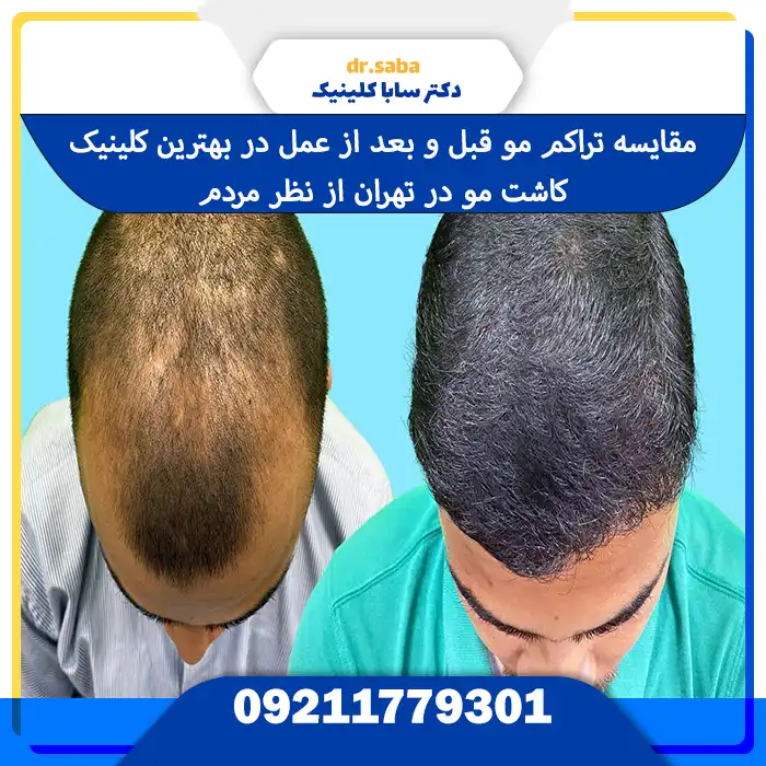 مقایسه تراکم مو قبل و بعد از عمل در بهترین و معتبر ترین کلینیک کاشت مو در تهران از نظر مردم