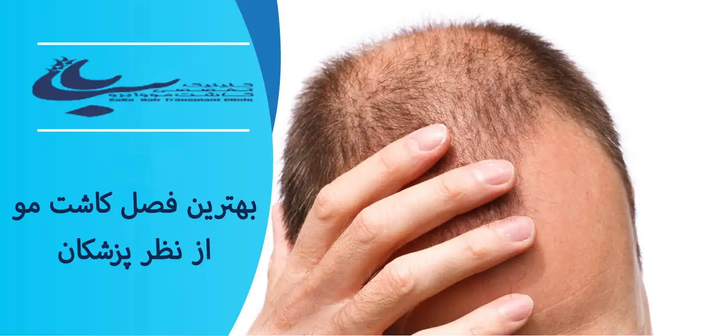 بهترین فصل کاشت مو از نظر پزشکان