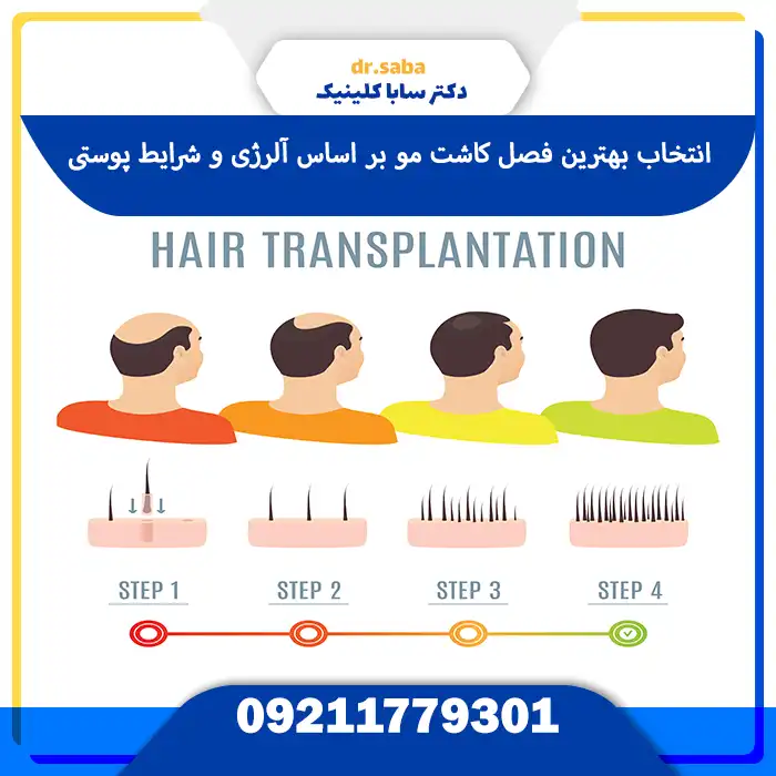 بهترین زمان برای کاشت مو در قصول مختلف با حساسیت ها