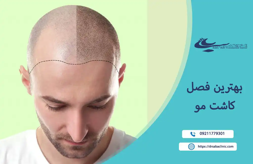 کاشت مو در بهترین فصل سال