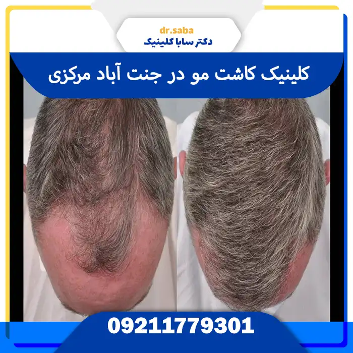 کلینیک کاشت مو در جنت‌آباد مرکزی