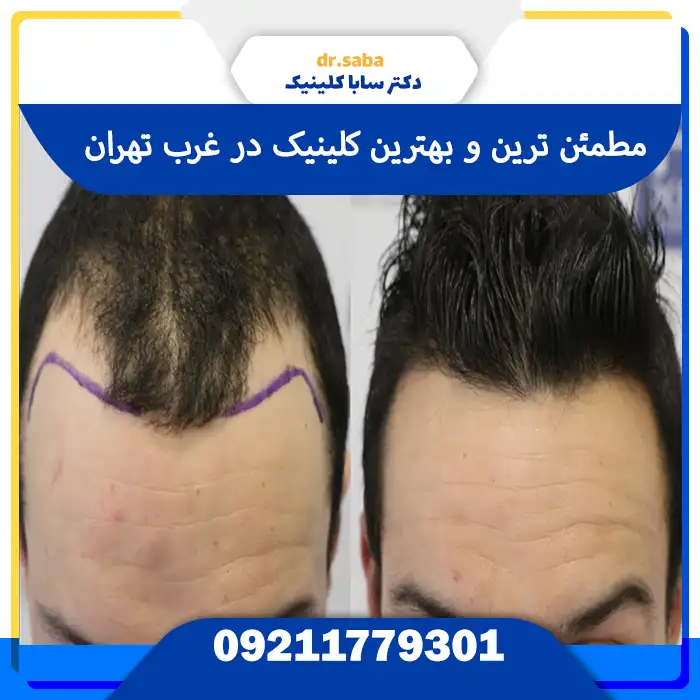 کلینیک کاشت مو در غرب تهران با تجهیزات مدرن
