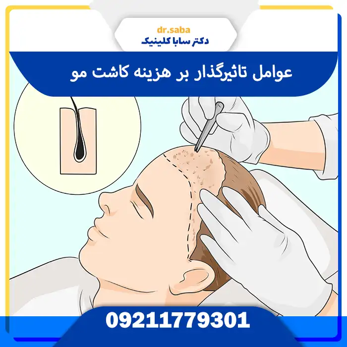 کاشت مو در غرب تهران