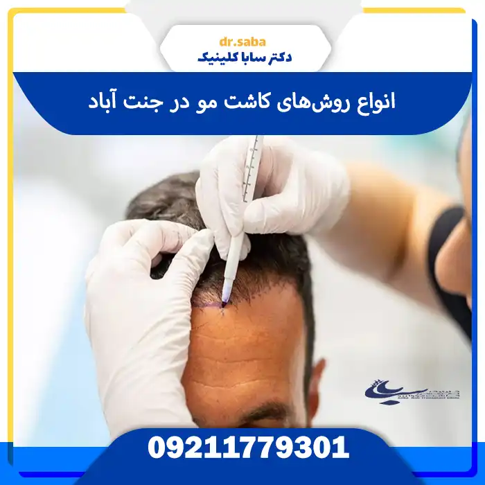 کلینیک کاشت مو در جنت آباد