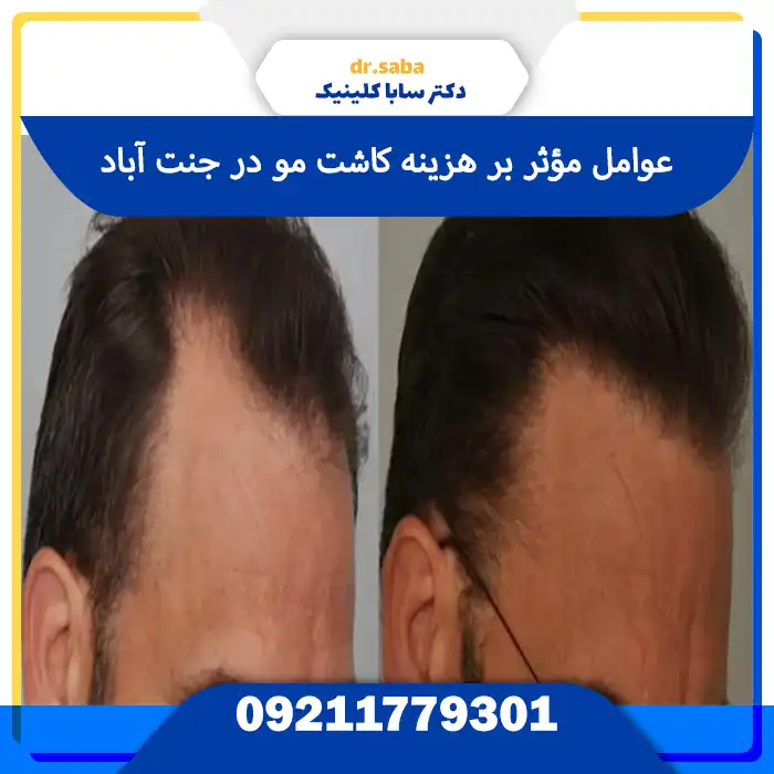 کلینیک کاشت مو در جنت آباد