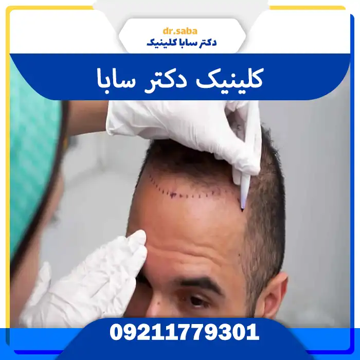 کلینیک کاشت مو در جنت آباد