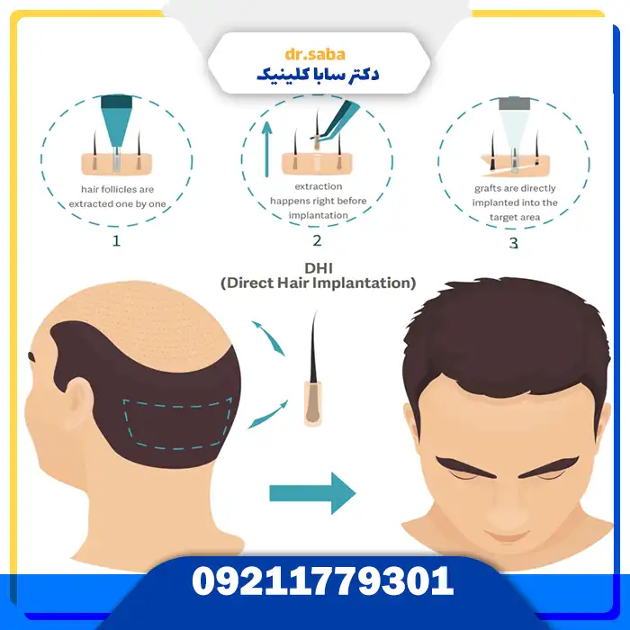 کلینیک کاشت مو در غرب تهران با تجهیزات مدرن