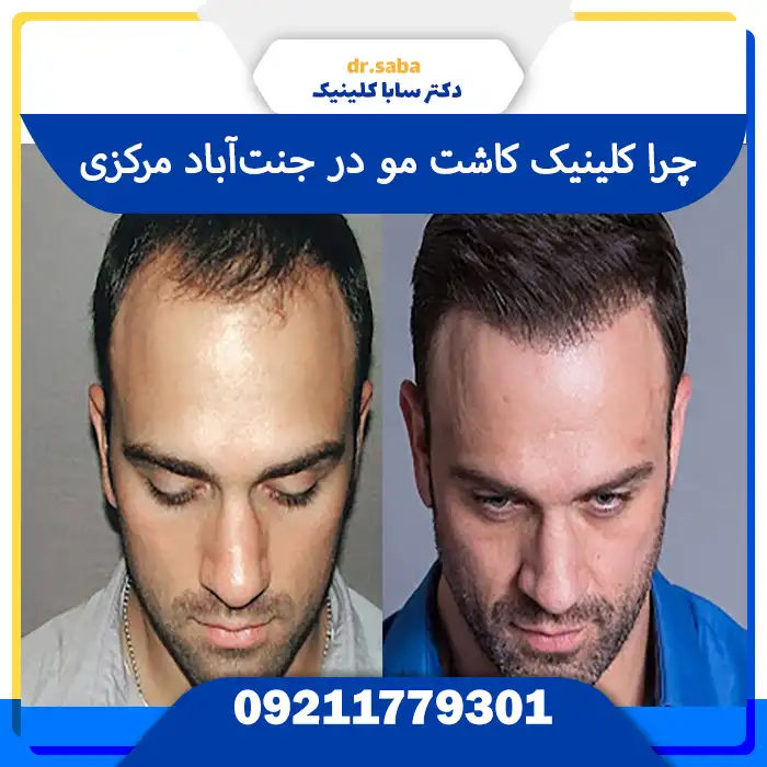 کلینیک کاشت مو در جنت‌آباد مرکزی