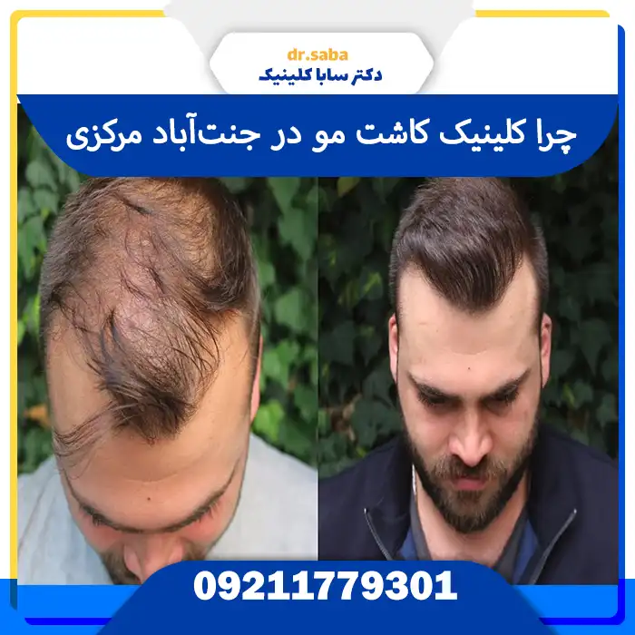 کلینیک کاشت مو در جنت‌آباد مرکزی