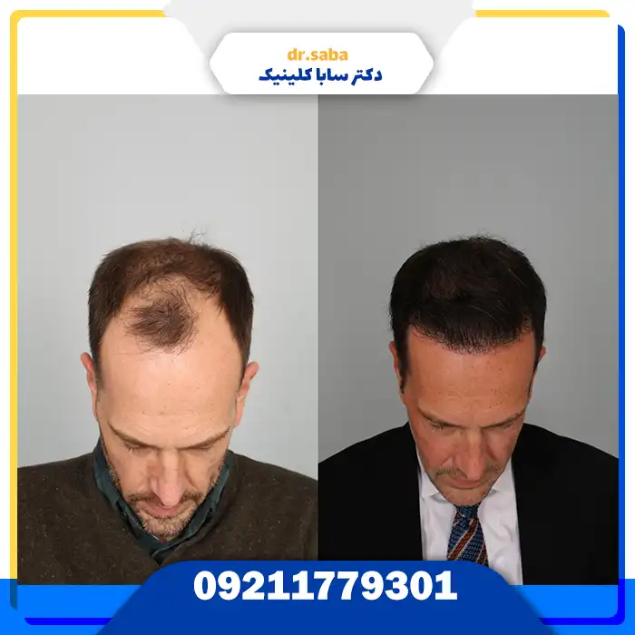 کلینیک کاشت مو در غرب تهران با تجهیزات مدرن