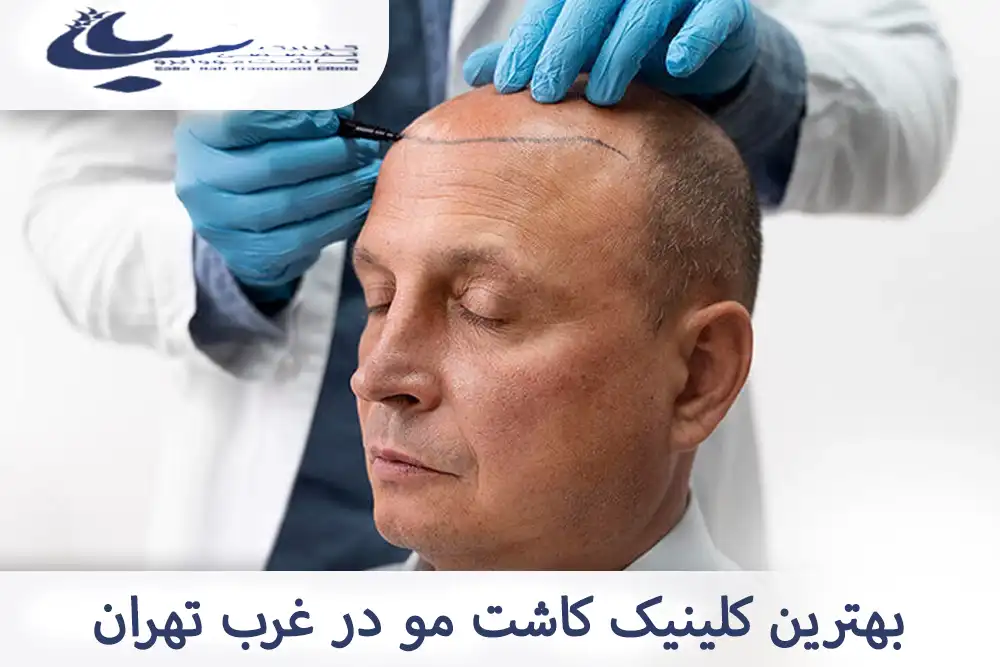 کلینیک کاشت مو در غرب تهران با تجهیزات مدرن