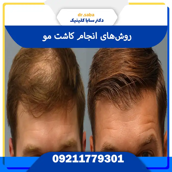 کاشت مو در جنت‌آباد مرکزی