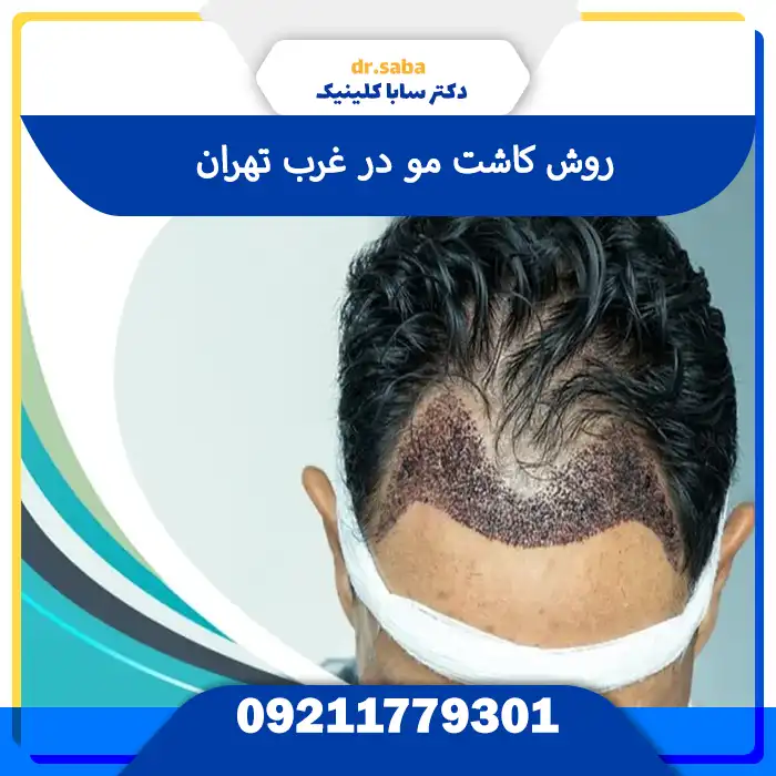 کلینیک کاشت مو در غرب تهران با تجهیزات مدرن