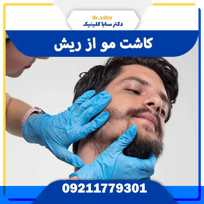 کاشت مو از ریش توسط پزشک متخصص در سابا کلینیک
