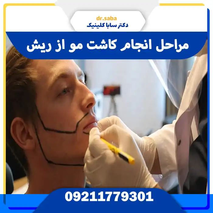 مراحل انجام کاشت مو از ریش 