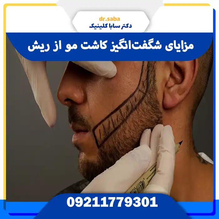 مزایای شگفت‌انگیز کاشت مو از ریش