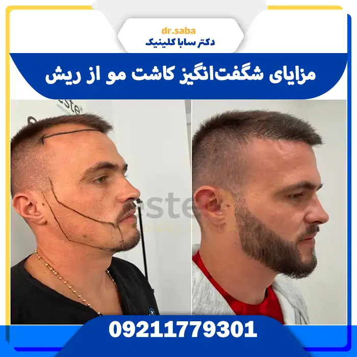 آیا کاشت مو از ریش درد دارد؟