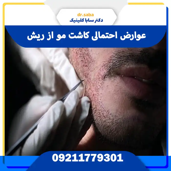 عوارض احتمالی کاشت مو از ریش