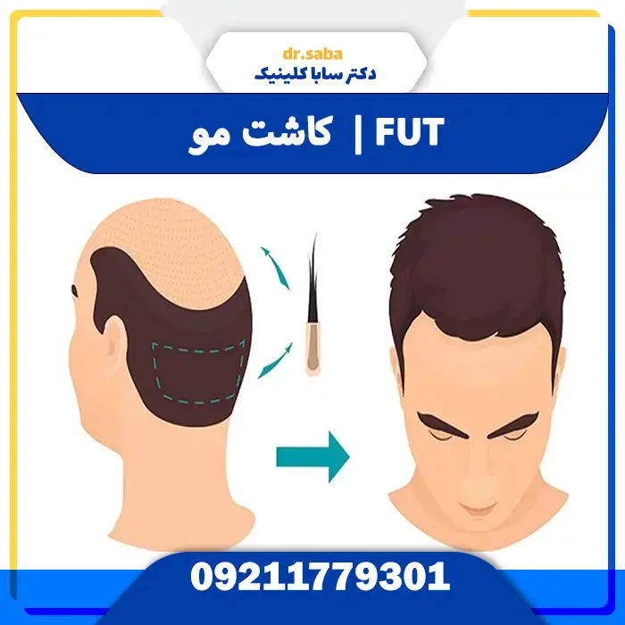 کاشت مو در روش FUT و مراحل آن