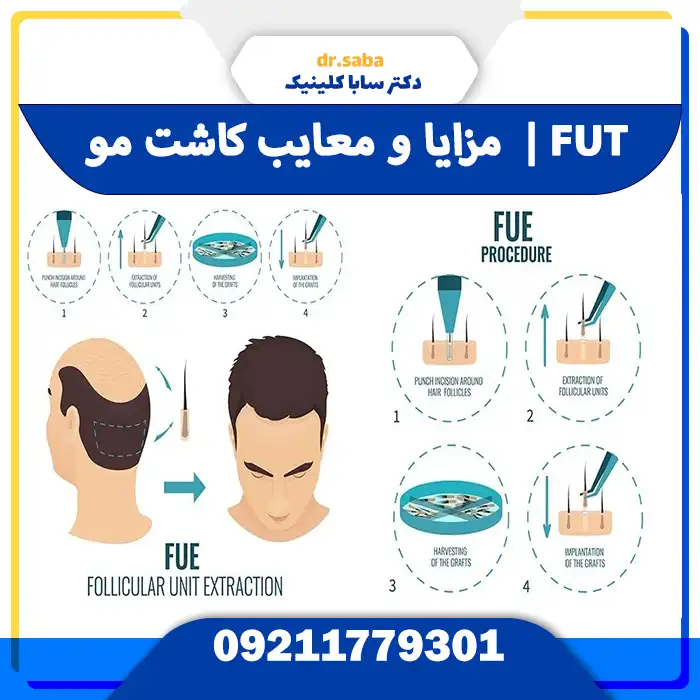 مزایا و معایب کاشت مو به روش FUT