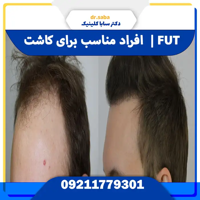 افراد مناسب برای کاشت مو به روش FUT