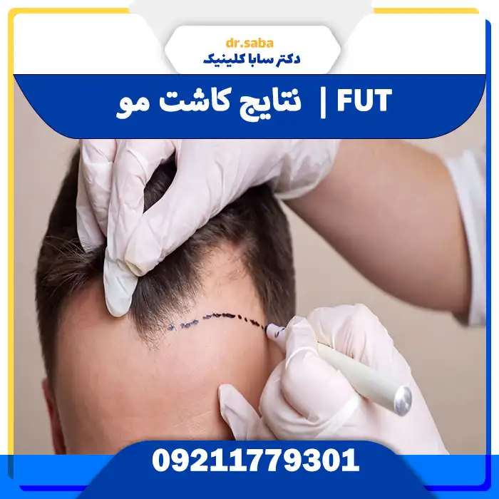 نتایج کاشت مو به روش FUT